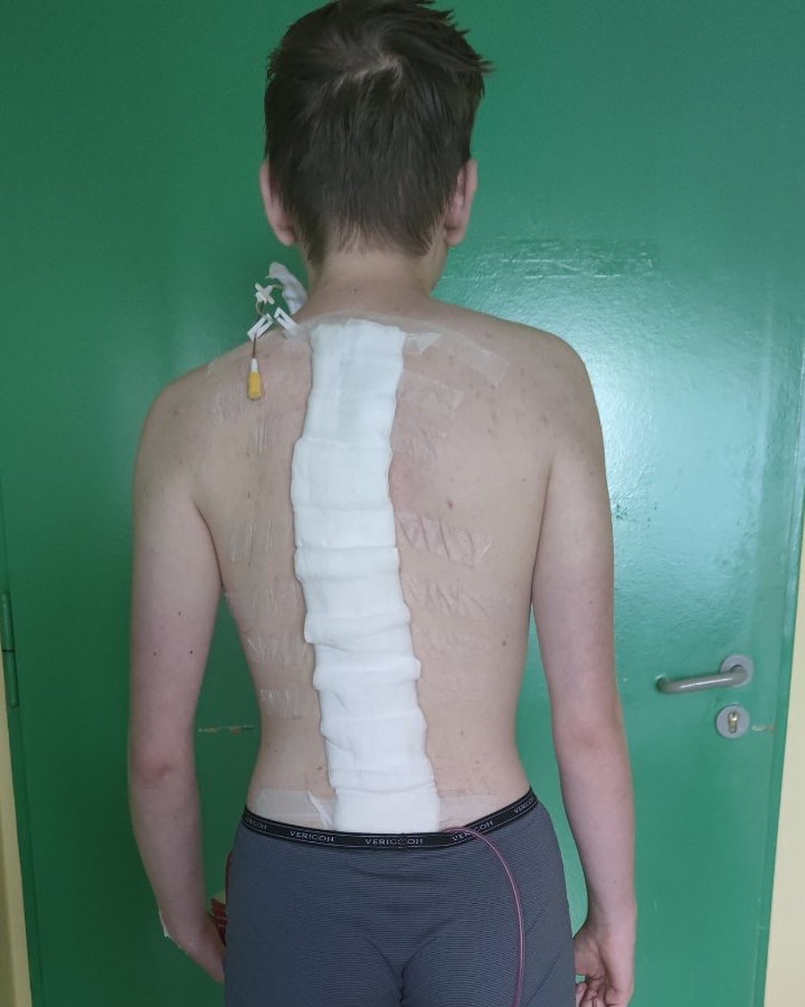 The back of a boy with a bandage on his back.